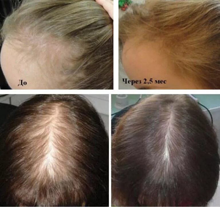 Выпадение волос после маски. Волосы после луковой маски до и после. Волосы до и после витаминов. Касторовое масло для волос до и после. Витамины для роста волос до и после.