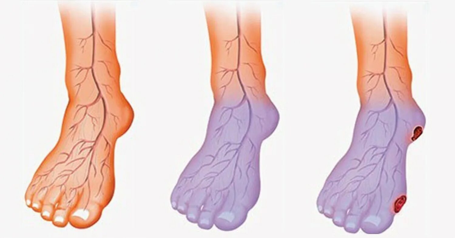 Нарушение кровообращения в сосудах. Облитерирующий атеросклероз вен нижних конечностей. Атеросклероз нижних конечностей гангрена. Диабетическая ангиопатия ног. Облитерирующий тромбофлебит.