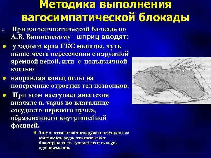 Блокада техника выполнения. Вагосимпатическая блокада методика. Шейная вагосимпатическая новокаиновая блокада. Вагосимпатическая блокада по Вишневскому. Выполнения вагосимпатической блокады по Вишневскому.