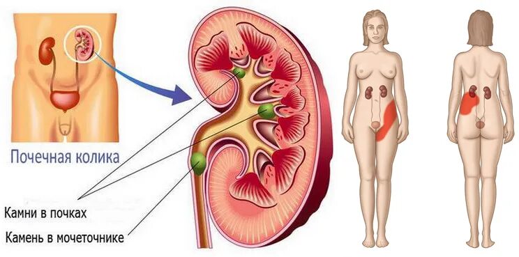 Ноющая боль в левой почке. Локализация боли в почках. Почечная колика.