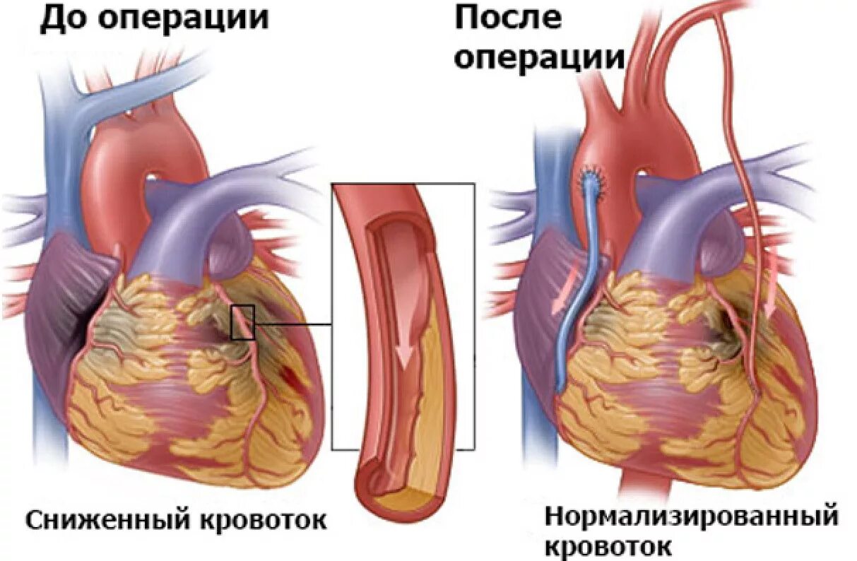 Что такое шунтирование сердца и сосудов. Инфаркт миокарда шунтирование. операция шунтирование сердца инфаркт. шунтирование сердца и стентирование при инфаркте миокарда. аутовенозное аортокоронарное шунтирование.