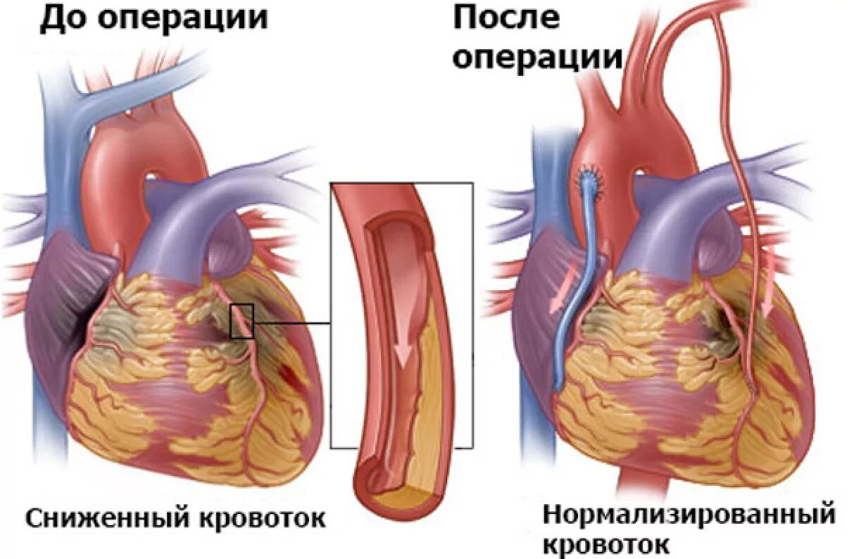 Инфаркт миокарда шунтирование. Операция шунтирование сердца инфаркт. Шунтирование сердца и стентирование при инфаркте миокарда. Аутовенозное аортокоронарное шунтирование. Что такое шунтирование сердца и сосудов