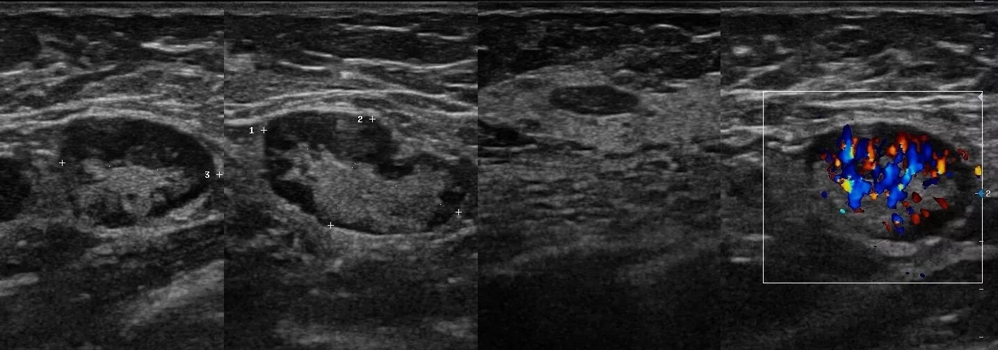 Лимфогранулематоз УЗИ лимфоузлов. Лимфатический узел щитовидной железы УЗИ. Острый Гнойный лимфаденит УЗИ. Лимфома лимфатического узла на УЗИ. Рецидив лимфоузлов