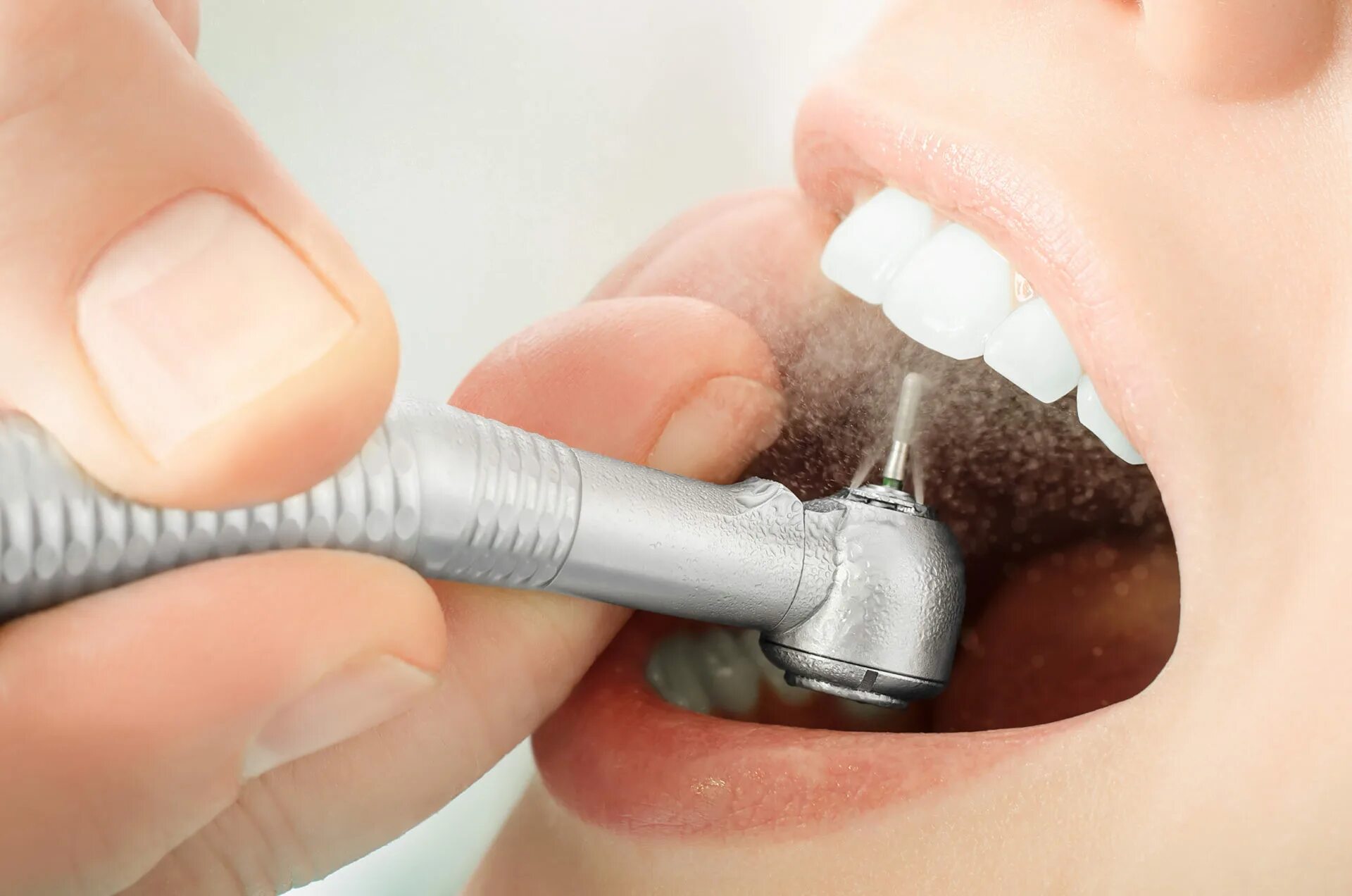 Аппарат АИР флоу стоматология. Профессиональная гигиена полости рта.