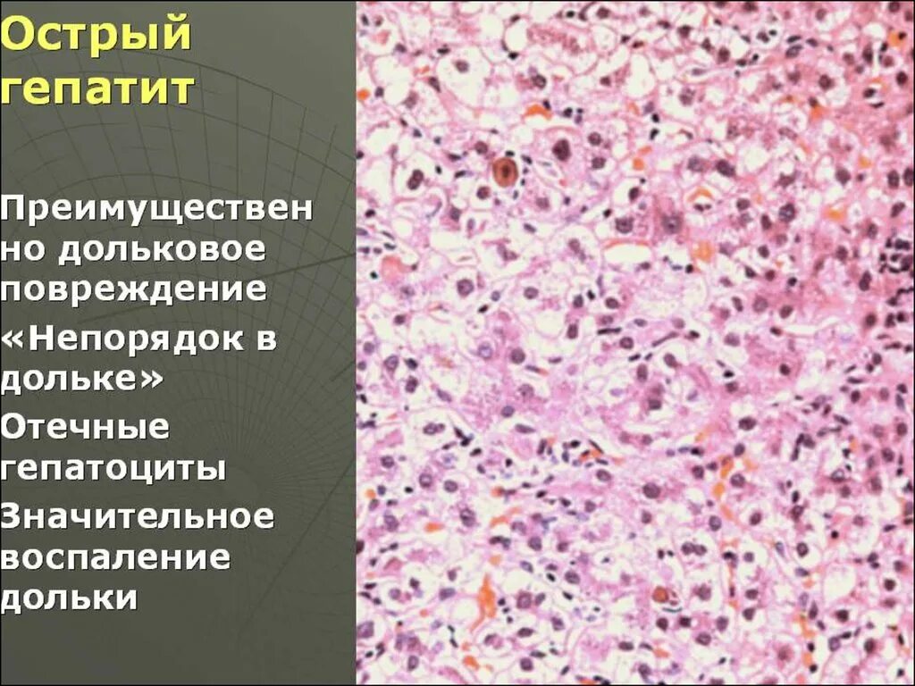 Молоко при гепатите. Острый гепатит симптомы.