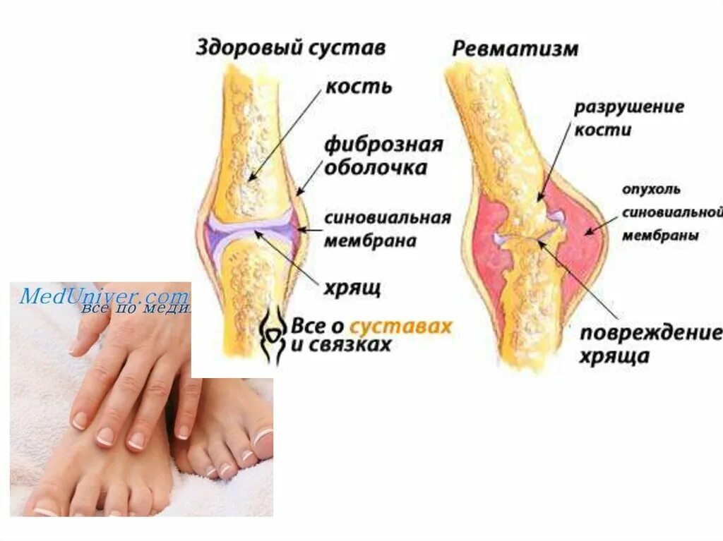 Ревматическое поражение суставов. Суставной ревматизм симптомы. Ревматизм поражение суставов. Симптомы суставного ревматизма. Ревматизм презентация.