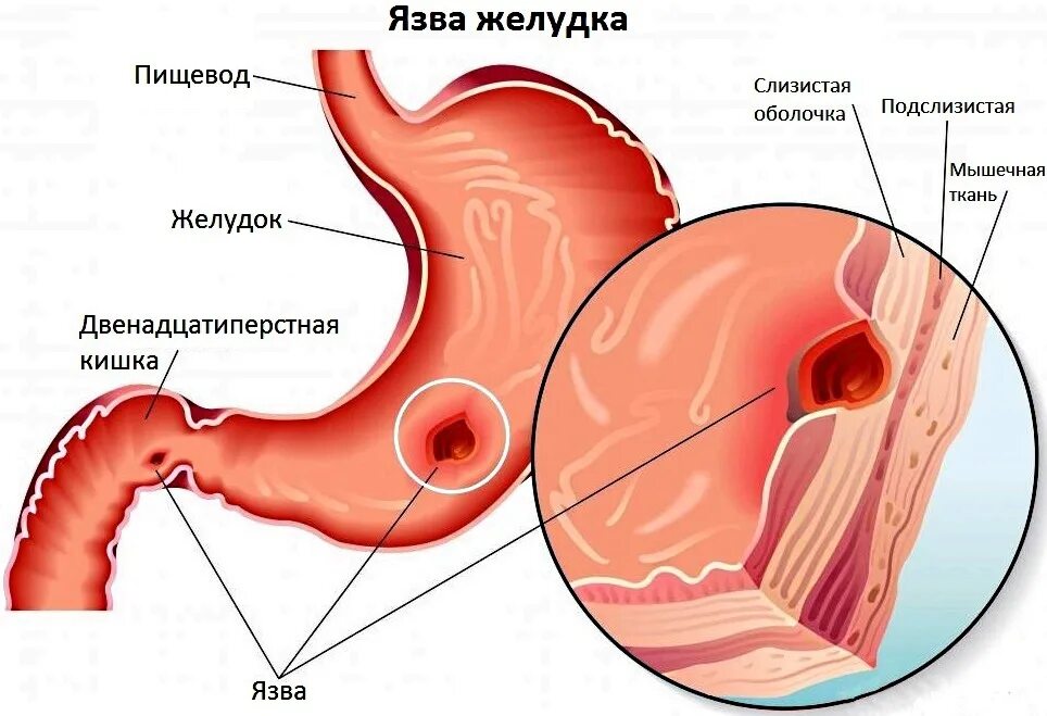 Боли после язвы желудка. Язвенная болезнь желудка и 12 перстной кишки. Язвенная болезнь желудка и двенадцатиперстной кишки ФГДС. Язвенная болезнь 12-перстной кишки ФГДС.