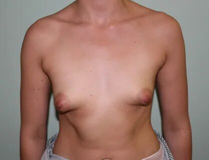 Tuberous-breast-correction-patient1-befo. 