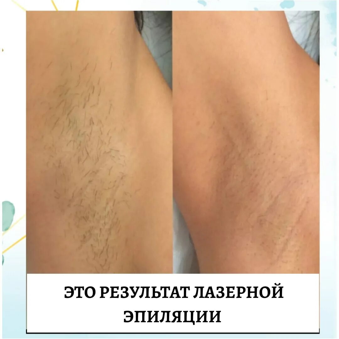 Сколько нужно сеансов лазерной эпиляции. Лазерная эпиляция подмышек. лазерная депиляция подмышки. шугаринг или лазерная эпиляция. подмышек до лазерной эпиляции.