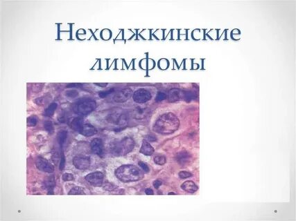 Злокачественная опухоль лимфомы