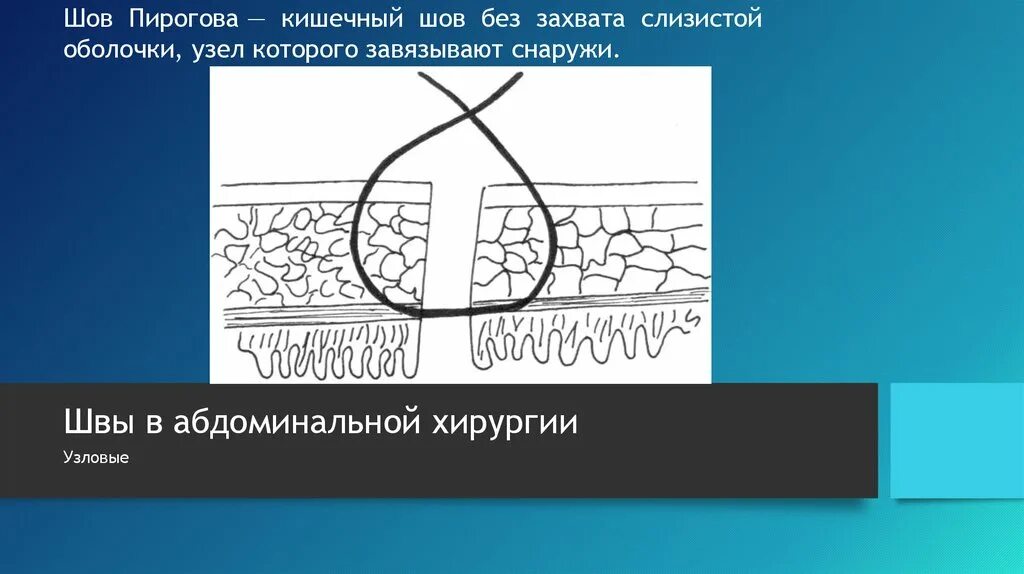 Шов 9. Шов пирогова черни кишечных швов. шов пирогова матешука. однорядный шов пирогова. кишечный шов пирогова матешука.