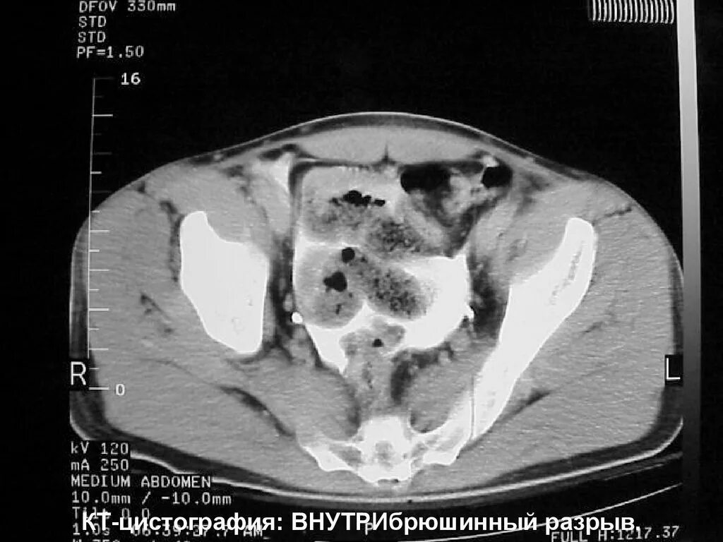 Разрыв мочевого пузыря на кт. Компьютерная томография мочевого пузыря. Травмы мочевого пузыря кт.