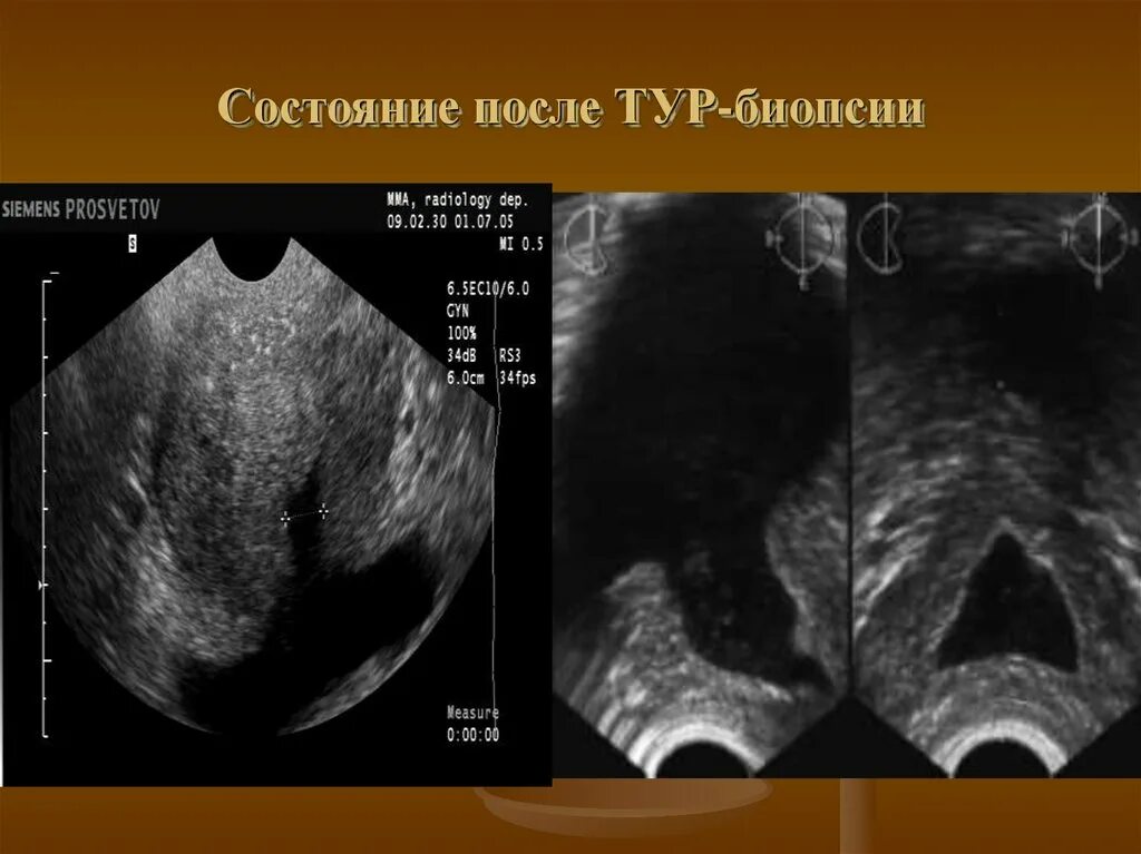 УЗИ после тур предстательной железы. Простата после тур на УЗИ. Состояние после тур на УЗИ. Состояние после тур простаты.