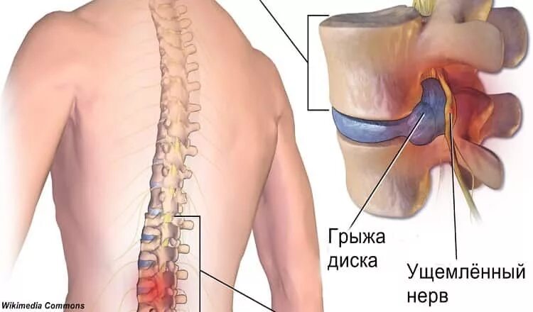 L4-L5 L5-S1 Transforaminal Injections #HipProblems Injections, Spondylolisthesis