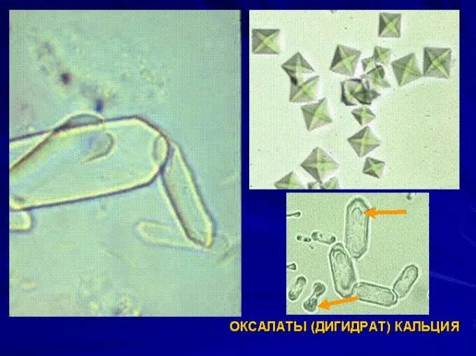 Оксалаты кальция в моче под микроскопом. Струвиты микроскопия. Струвиты и оксалаты микроскопия. Оксалаты кальция в осадке мочи. Кристаллы кальция в моче у мужчин