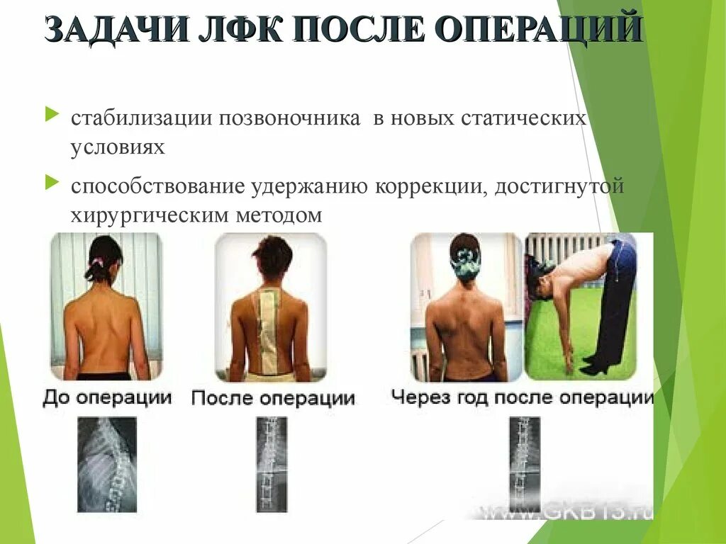 Стабилизирующие операции на позвоночнике