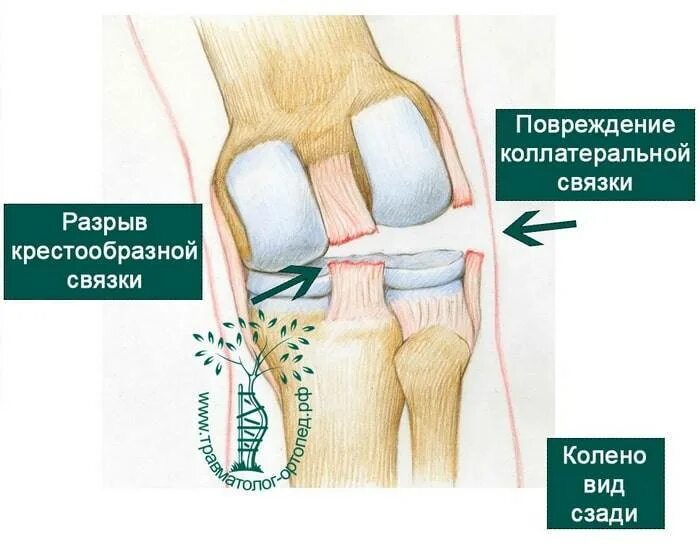 Разрыв связок ПКС коленного сустава. Коллатеральная связка коленного сустава. Разрыв коллатеральной связки коленного сустава. Разрыв боковой связки коленного сустава травматология. Симптомы крестообразной связки коленного сустава