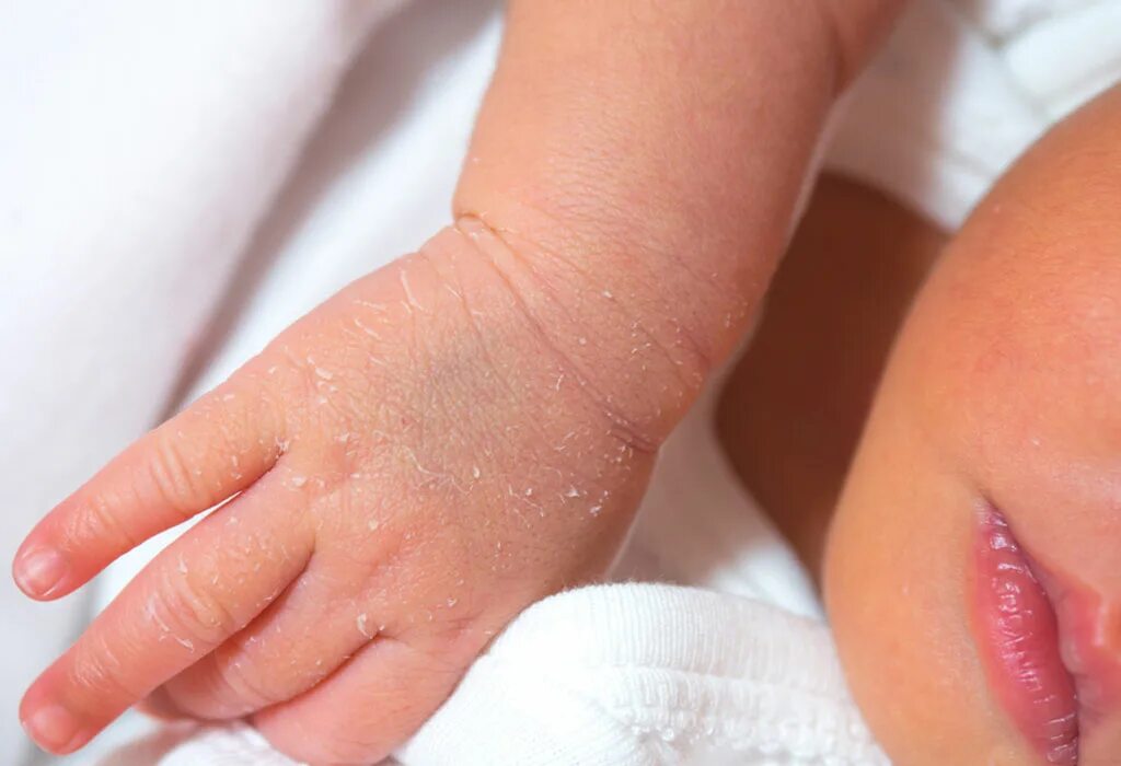Детский кожный. Шелушение кожи у новорожденного.