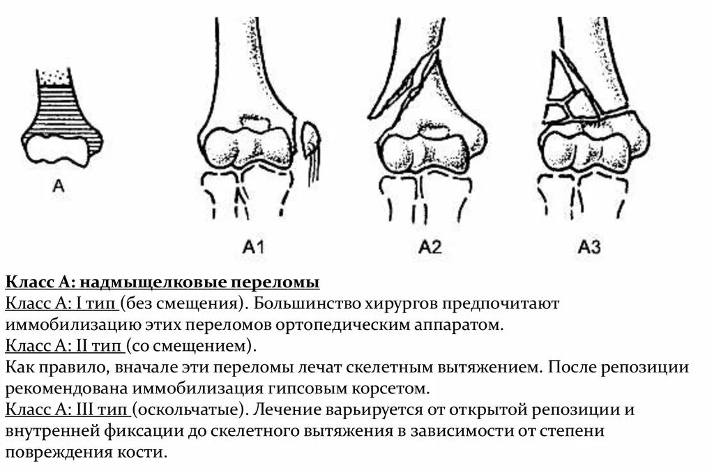 перелом надмыщелка плечевой кости рентген. разгибательный надмыщелковый перелом. переломы плечевой кости в дистальной части. надмыщелковый перелом плечевой кости. надмыщелковый перелом плечевой кости.