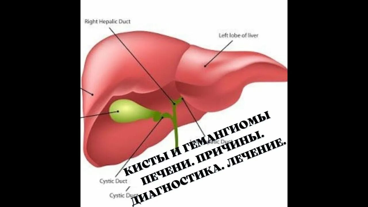Народное лечение гемангиома печени. Многокамерная киста печени. киста и гемангиома в печени. жить без желчного пузыря.