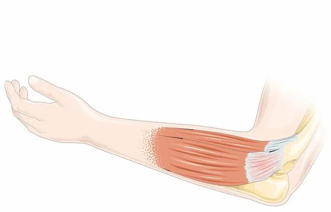 Почему болят локтевые сгибы. Медиальный эпикондилит сухожилия. Латеральный эпикондилит. Тендинит сухожилия предплечья. Латеральный эпикондилит локтевого сустава.
