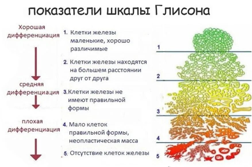 Стадии предстательной железы прогноз. Классификация Глисон предстательной железы. Гистологическая классификация опухолей предстательной железы. Шкала Глисона предстательной железы. Классификация РПЖ шкала Глисона.