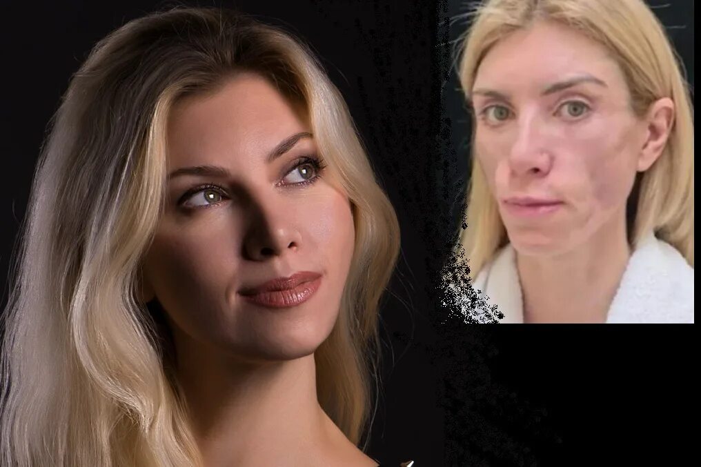Юля после пластики