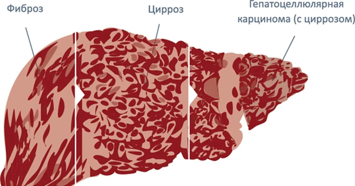 Сколько живут с фиброзом. Врожденный фиброз печени. Перивенулярный фиброз. Фиброз печени макропрепарат.