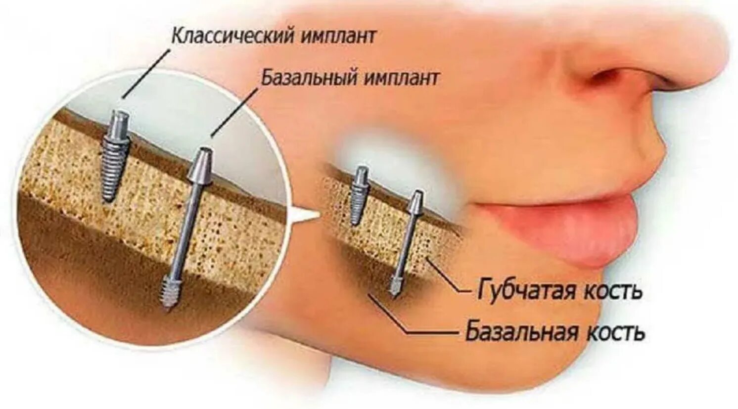 Базальной имплантация методика. Базальная имплантация зубов. Имплант базальная имплантация. Hard bone