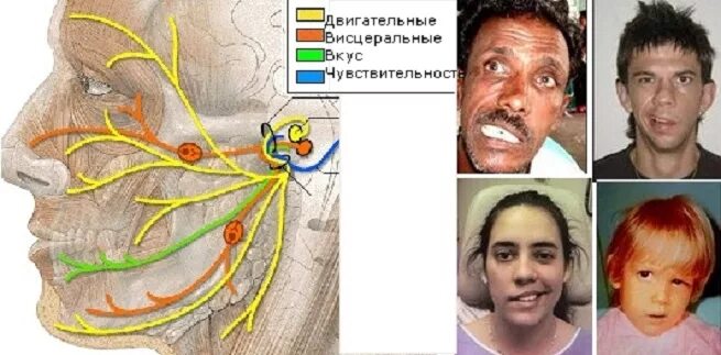 Повреждение нервов лица