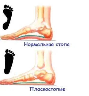 Плоскостопие сильно болят ноги