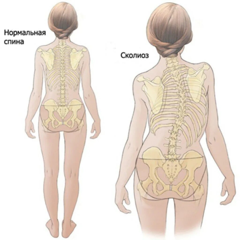 Нормальная поясница. Сколиотическая деформация позвоночника. Сколиоз и сколиотическая болезнь. Искривлениепозвоничника. Искривление позвоночника 4 степени.
