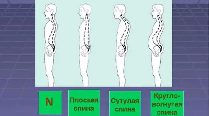 Вогнуто круглая спина. Вогнуто круглая спина. Плоская спина рисунок. Кругло вогнутая осанка. Вогнуто круглая спина.