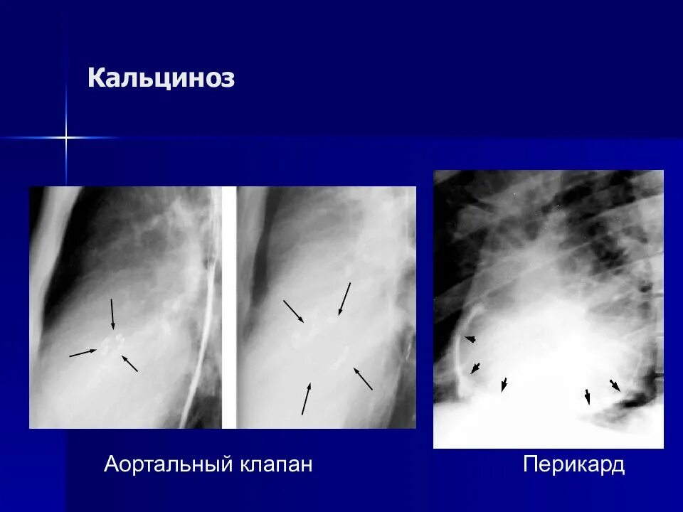 Кальциноз митрального клапана. Кальциноз клапанов сердца рентген. Симптомы кальциноза митрального клапана. Аортальный стеноз рентген. Кальциноз створок клапанов сердца.