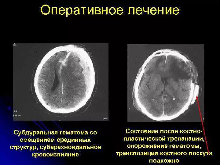 Кт субдуральной гематомы. Субдуральная гематома ГМ. Инфратенториальная субдуральная гематома. Субдуральная гематома смещение срединных. Гематома мозга операция