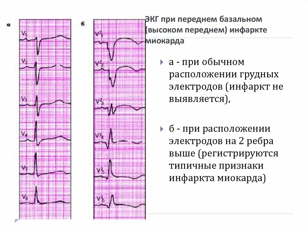 Изменения боковых отделов. Инфаркт миокарда передней перегородки на ЭКГ. ЭКГ критерии заднего инфаркта миокарда. Высокий передний инфаркт миокарда на ЭКГ. ЭКГ передне перегородочный инфаркт миокарда левого желудочка.