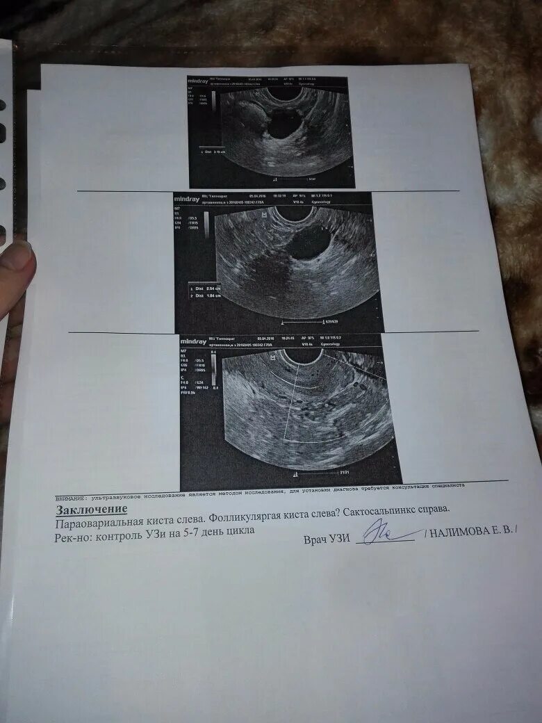 Надо ли удалять параовариальную кисту. Параовариальные кисты УЗИ. Параовариальная киста протокол УЗИ. Параовариальная киста яичника заключение УЗИ. Кисты яичников УЗИ протокол.