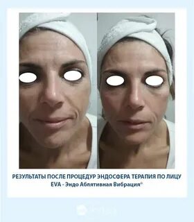 Эндосфера до и после фото