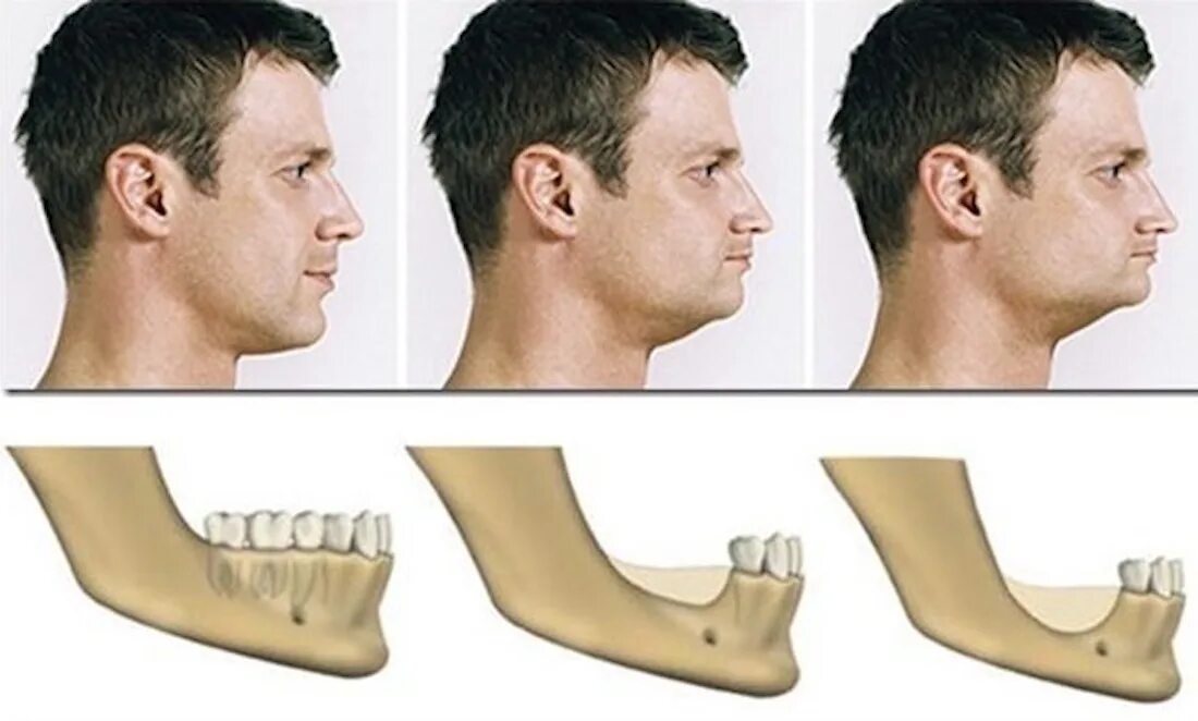 Атрофия костной ткани челюсти. Атрофия костной ткани челюсти зубы. Отмирание костной ткани челюсти. Атрофия кости челюсти и имплант.