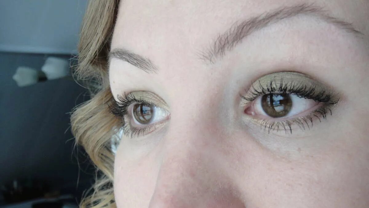 Косоглазые до и послетоперпции. Одно нависшее веко. Операция по коррекции косоглазия. Отзыв исправление косоглазия. Косоглазие до и после операции.