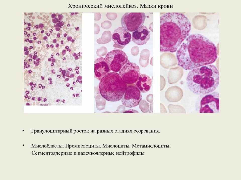 Метамиелоциты. Миелобласты миелоциты. промиелоциты и миелоциты. миелоциты и метамиелоциты. миелоциты промиелоциты метамиелоциты.
