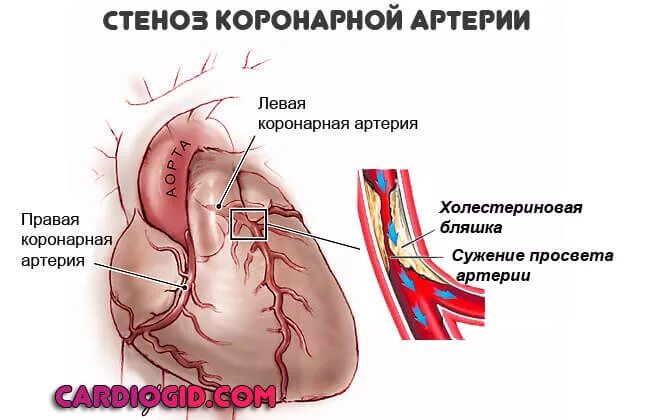 Расширение сердечного сосуда. Атеросклероз венечных артерий сердца. Стеноз коронарных сосудов. Правая коронарная артерия стеноз 80 процентов. Стеноз венечных артерий.