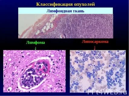 Ткань название опухоли