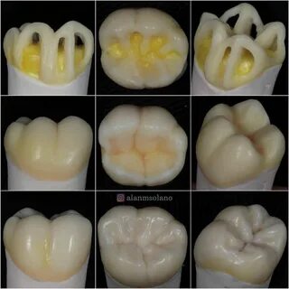 Моделирование коронки