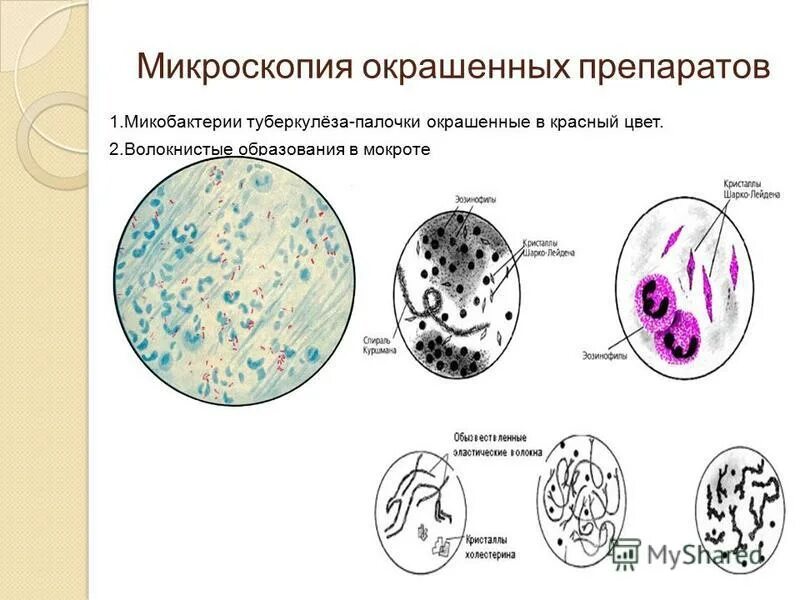 В мокроте можно обнаружить. Мокрота нативный препарат микроскопия. Микроскопия мокроты окрашенный препарат. Анализ мокроты при микроскопии. Эластические волокна в мокроте микроскопия.