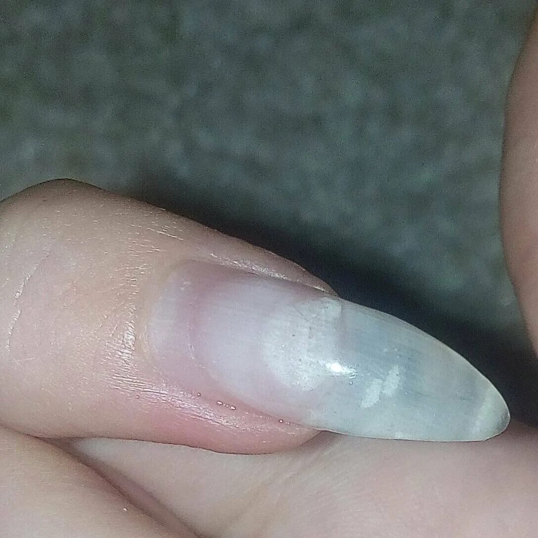 Белые точки под ногтями. Белые точки под ногтями. Белое пятно на ногте мизинца. Лейконихия белые пятна на ногтях. Псориатическая лейконихия.