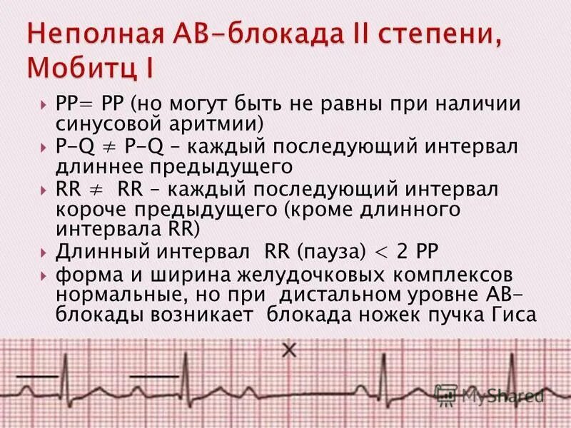 Что означает неполная блокада. Неполная блокада. Полная и неполная блокада. Синусовая аритмия у детей. Полная атриовентрикулярная блокада аритмия.