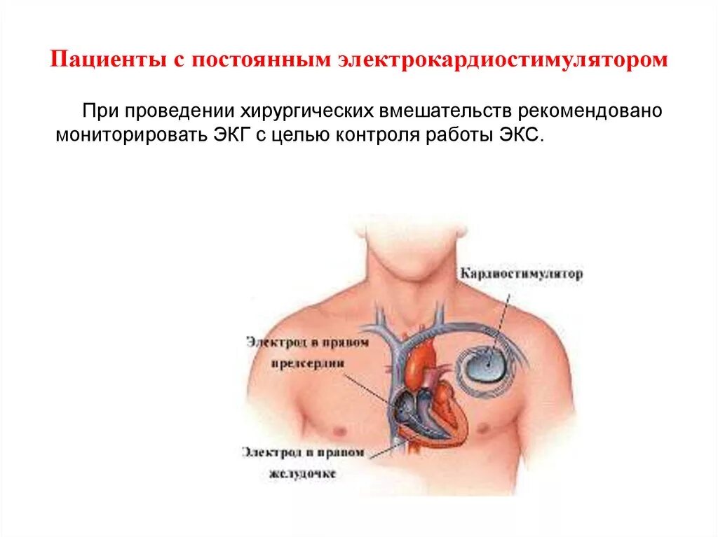 Имплантация электрокардиостимулятора. Постоянный электрокардиостимулятор. Установленный кардиостимулятор. Почему в инструкции людям с кардиостимуляторами запрещается