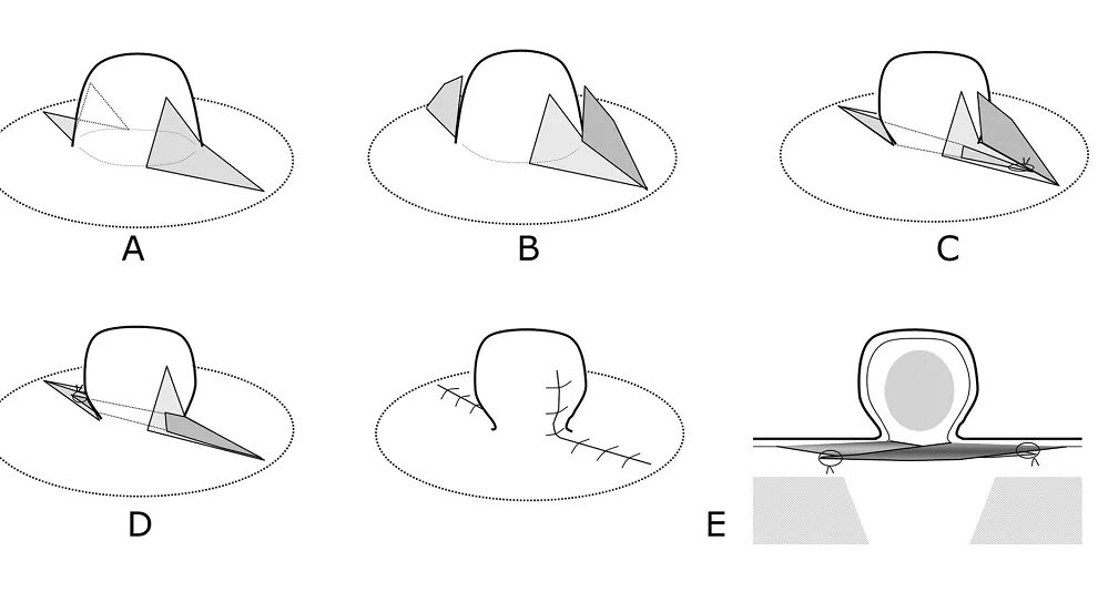 Плоский сосок. Шприц для вытягивания сосков. Железа монтгомери на ореолах. Почему нету сосков. Плоская форма сосков.