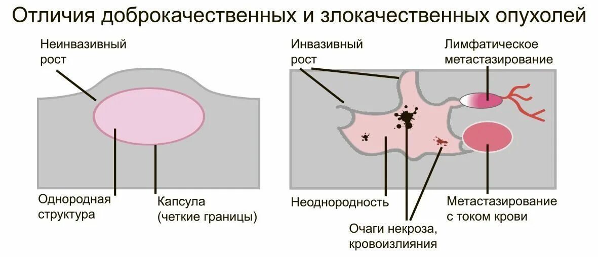 Как отличить раковую опухоль от доброкачественной. Отличие доброкачественной и злокачественной опухоли молочной. Строение доброкачественной и злокачественной опухоли. Злокачественная опухоль и доброкачественная отличие.